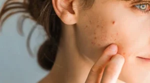 Cicatrices d’acné Fes maroc dermatologue