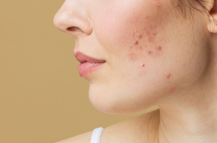 Cicatrices d’acné dermatologue fes