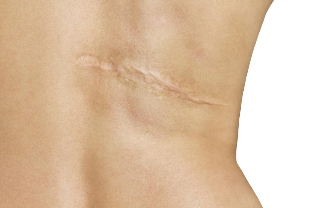 Cicatrices de brûlures dermatologue fes maroc