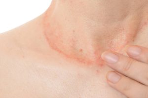 Eczéma de contact dermatologue Fès