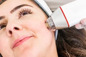 Microneedling avec radiofréquence maroc