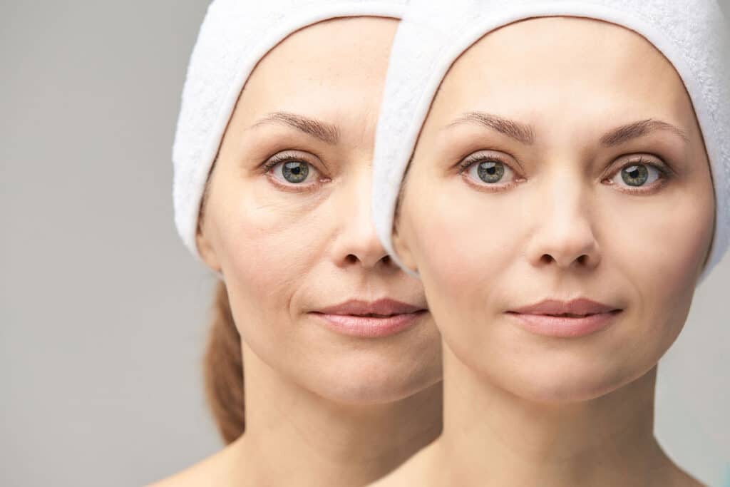 Rajeunissement du visage: Dermatologue a fes maroc