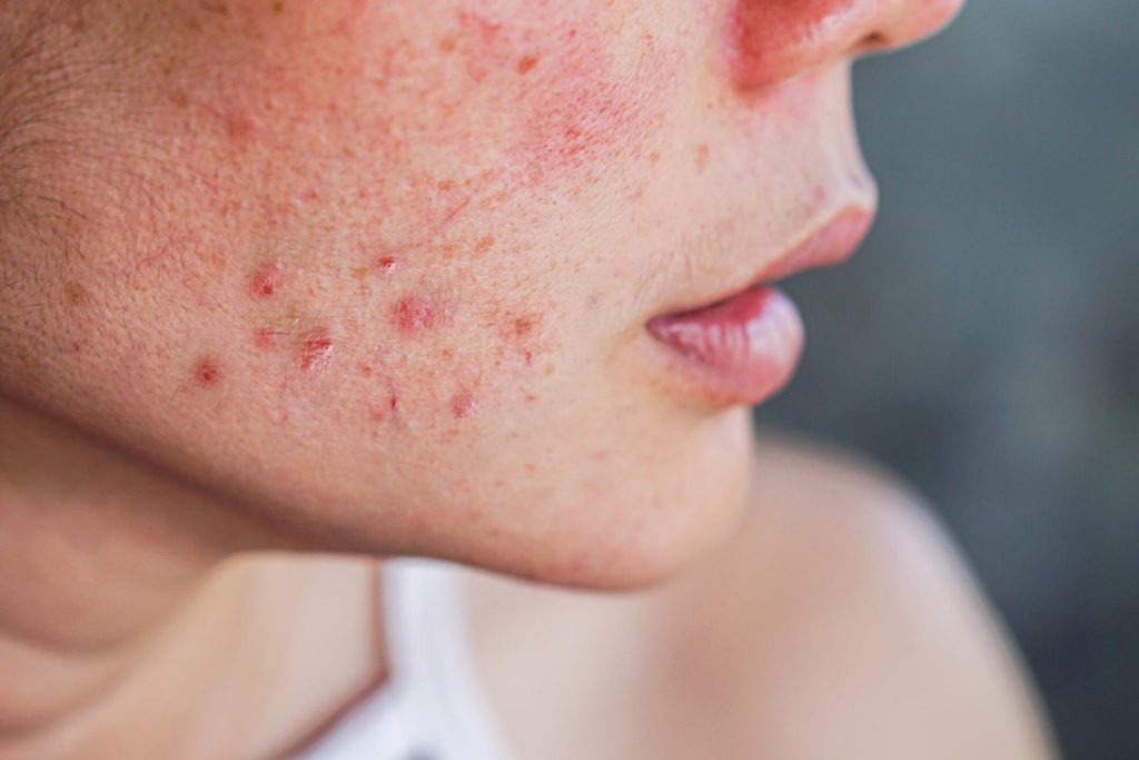 Rougeur de l’acné dermatologue fes maroc